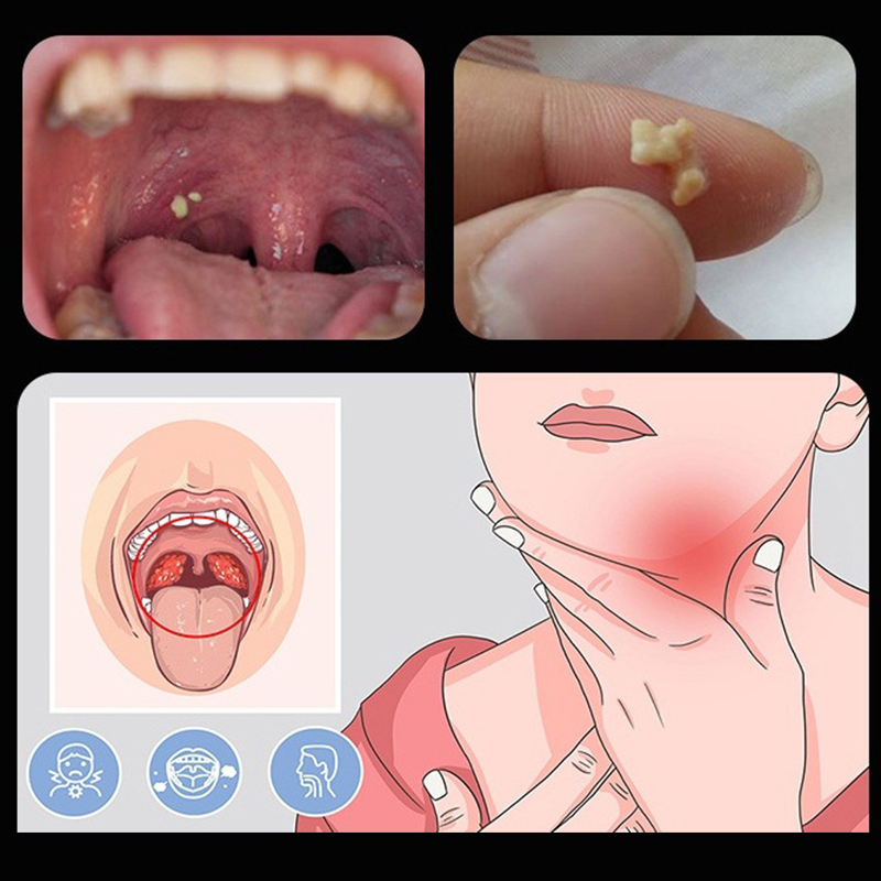~Ear Wax Tonsil Stone Remover  - đánh giá và giá Ear Wax Remover